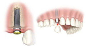 Fogászati implantáció